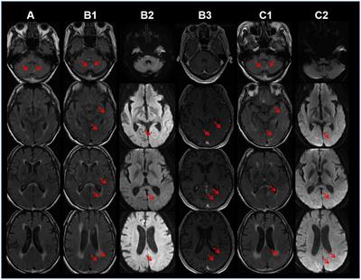 Neuronal Intranuclear Inclusion Disease Presenting with Acute-Onset Dementia and Cortical Edema: A Case Report